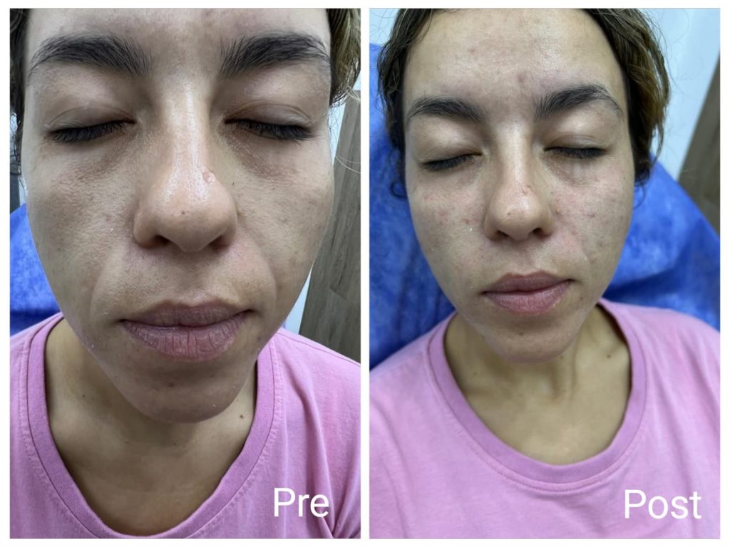 Cheek fillers before and after